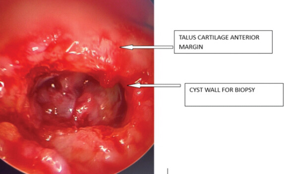 Figure 4: Cyst wall.