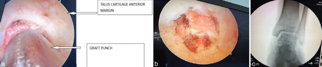 Figure 5: (a) Graft compressed into the cyst with punch, (b) showing bone graft well impacted, and (c) arm image showing well-impacted graft in the cyst.