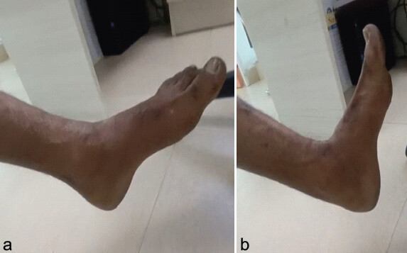 Figure 6: Full range of motion (a) plantar flexion, (b) dorsiflexion.