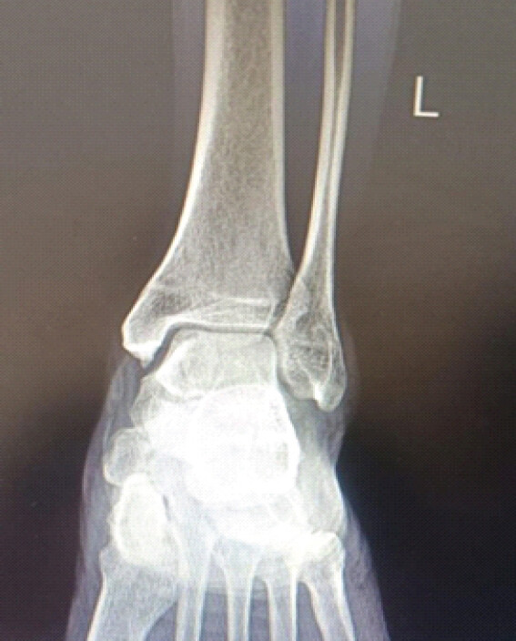 Figure 7: X-ray at 6 months follow-up showing consolidation.