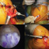 Clinical Outcomes of Staged Bilateral Middle Trapezius Transfer for Irreparable Supraspinatus Tendon Tears: A Case Report