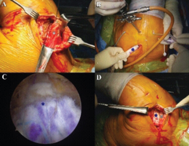 Figure 1: Surgical procedure of middle trapezius tendon transfer in the left shoulder. (a) The harvested middle trapezius tendon reinforced with a free suture construct. (b) Introduction of the interpositional graft into the subacromial space via the supraspinatus outlet. (c) Arthroscopic view from the lateral portal showing the interpositional graft securely fixed to the supraspinatus footprint using a suture-bridge technique. (d) Final attachment of the interpositional graft to the middle trapezius muscle. White asterisk, middle trapezius muscle; blue asterisk, interpositional graft.