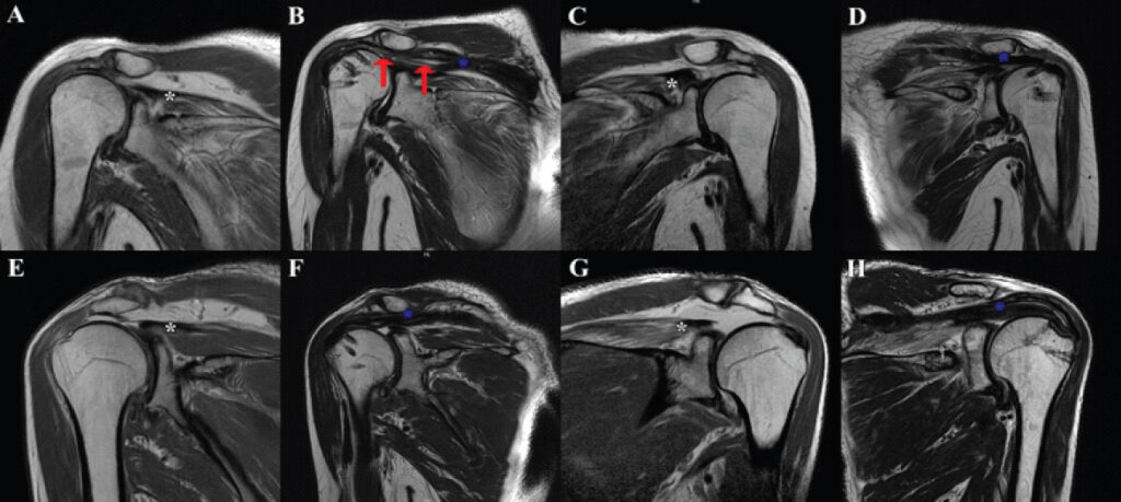 Figure 2: Bilateral shoulder magnetic resonance imaging. Patient 1: Pre-operative (a) and post-operative (b) right shoulder; pre-operative (c) and post-operative (d) left shoulder. Patient 2: Pre-operative (e) and post-operative (f) right shoulder; pre-operative (g) and post-operative (h) left shoulder. White asterisk, supraspinatus; blue asterisk, interpositional graft; red arrow, partial retear of the graft.