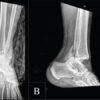 Posterior Fibular Entrapment in a Bosworth Fracture-Dislocation: A Case Report and Review of Diagnostic and Operative Considerations
