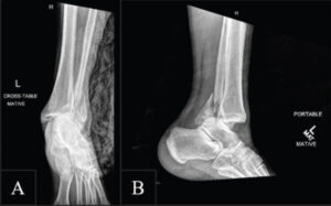 Figure 1: Radiographic images demonstrating ankle injury. (a) Oblique view showing a posterior malleolus fracture, an angulated distal fibular fracture, and associated tibiotalar dislocation. (b) Medial (lateral) view confirming the posterior malleolus involvement and the degree of tibiotalar displacement.