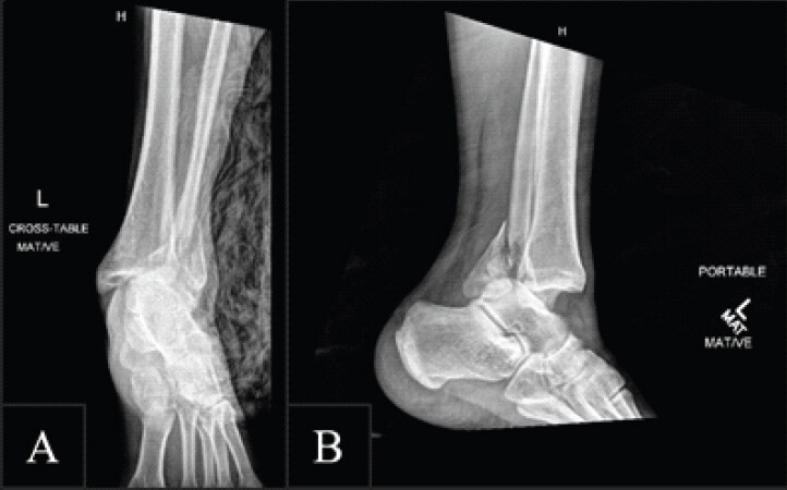 Figure 1: Radiographic images demonstrating ankle injury. (a) Oblique view showing a posterior malleolus fracture, an angulated distal fibular fracture, and associated tibiotalar dislocation. (b) Medial (lateral) view confirming the posterior malleolus involvement and the degree of tibiotalar displacement.