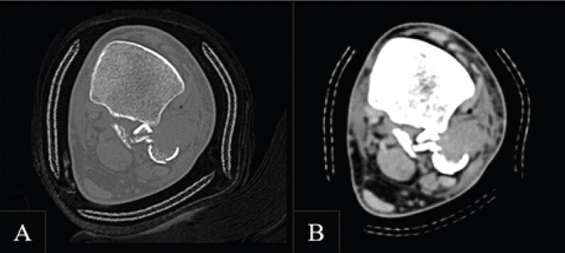 Figure 2: Axial computed tomography (CT) images demonstrating fibular entrapment (a and b). Axial CT slices showing posterior displacement of the fibula behind the posterior tibial tubercle, consistent with fibular entrapment.