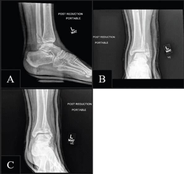 Figure 3: Post-reduction radiographs. (a) Lateral view demonstrating improved tibiotalar alignment but persistent posterior displacement of the distal fibula. (b) Anteroposterior view showing maintained mortise asymmetry with continued lateral malposition of the fibula despite attempted closed reduction. (c) Oblique anteroposterior view further confirming posterior fibular entrapment behind the posterior tibial tubercle, characteristic of a Bosworth injury.