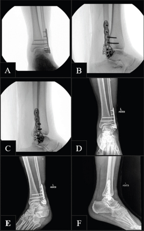 Figure 4: Intraoperative and postoperative imaging following open reduction and internal fixation of Bosworth fracture. (a) Fluoroscopic anteroposterior view showing definitive distal fibular plate fixation with lag screw stabilization of the anterior articular fragment. (b) Fluoroscopic oblique view best demonstrating lag screw fixation and two-screw stabilization of the syndesmosis. (c) Fluoroscopic lateral view confirming final hardware position and restored tibiotalar alignment. (d) Anteroposterior radiograph showing restored fibular length and alignment after reduction. (e) Oblique radiograph demonstrating improved mortise congruence with provisional mini-fragment plate fixation. (f) Lateral radiograph confirming anatomic reduction of the posteriorly displaced fibula.