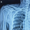 Massive Subcutaneous Emphysema with Bilateral Pneumothorax and Pneumoscrotum Following Clavicle Fracture without Rib Fracture: A Rare Case Report
