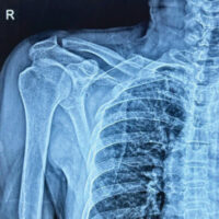 Figure 1: Pre-operative radiograph of right clavicle at presentation.