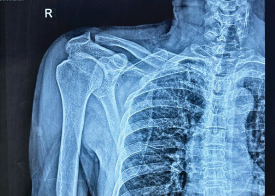 Figure 1: Pre-operative radiograph of right clavicle at presentation.