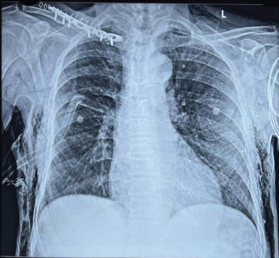 Figure 4: Post-operative chest radiograph following clavicle fixation with intercostal drainage (ICD) tube in situ.