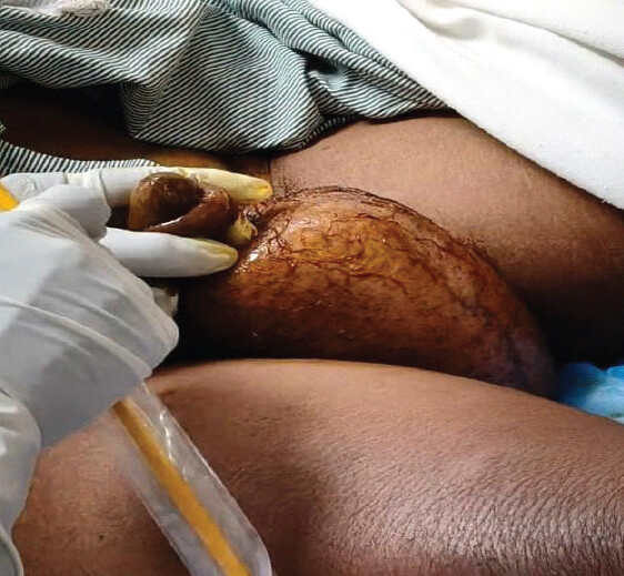 Figure 5: Clinical image showing pneumoscrotum as a complication.