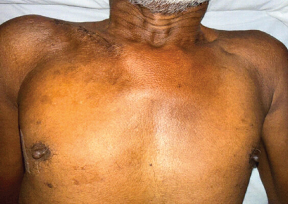 Figure 6: Clinical image showing increased swelling over the right side of the chest compared to the left.