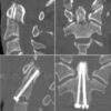 Bilateral Medial Medullary Syndrome Following Anterior Odontoid Screw Fixation for a Type II Fracture: A Case Report