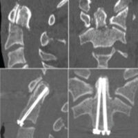 Figure 1: Cervical computed tomography (CT) imaging. (a) Preoperative CT showing the displaced type II odontoid fracture. (b) Postoperative CT showing satisfactory reduction and correct positioning of the two odontoid screws.