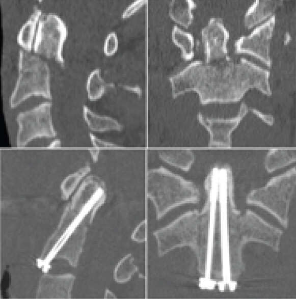 Figure 1: Cervical computed tomography (CT) imaging. (a) Preoperative CT showing the displaced type II odontoid fracture. (b) Postoperative CT showing satisfactory reduction and correct positioning of the two odontoid screws.