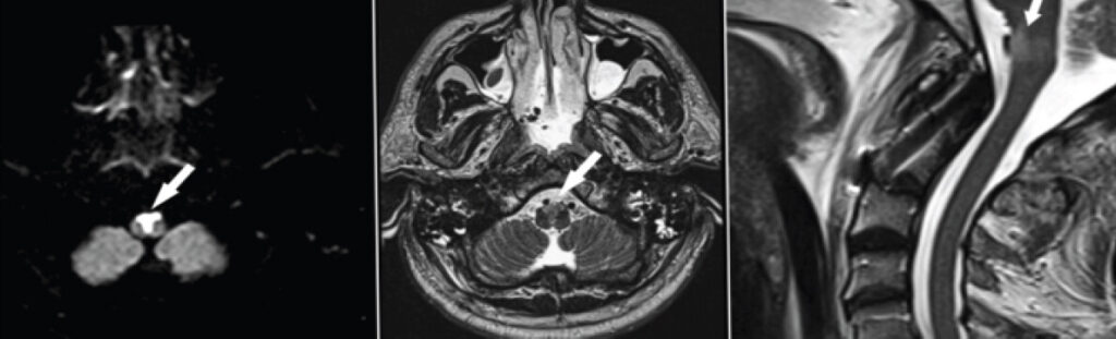 Figure 2: Magnetic resonance imaging after failed weaning. Diffusion-weighted imaging shows restricted diffusion with a high signal in the anterior medulla (left), with a corresponding high T2 signal on axial imaging (middle); the ischemic lesion lies in close proximity to the surgical field and vertebral artery on sagittal imaging (right).