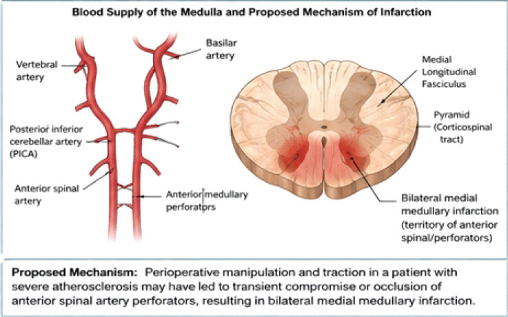 Figure 3: Schematic diagram of the blood supply of the medulla and the proposed mechanism of infarction. The vertebral arteries give rise to the anterior spinal artery through anterior medullary perforators, which supply the paramedian medulla, including the pyramids (corticospinal tracts) and medial longitudinal fasciculus. Perioperative manipulation and traction in a patient with severe atherosclerosis may have led to transient compromise or occlusion of anterior spinal artery perforators, resulting in bilateral medial medullary infarction.