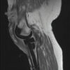Right Knee Ureaplasma Septic Arthritis in an Immunocompromised Host, Requiring Right Hip Disarticulation for Definitive Source Control