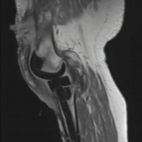 Figure 1: Lateral suprapatellar collection in communication with the joint space and femoral implant, with cutaneous sinus tract after a repeat Stage I revision right total knee replacement.