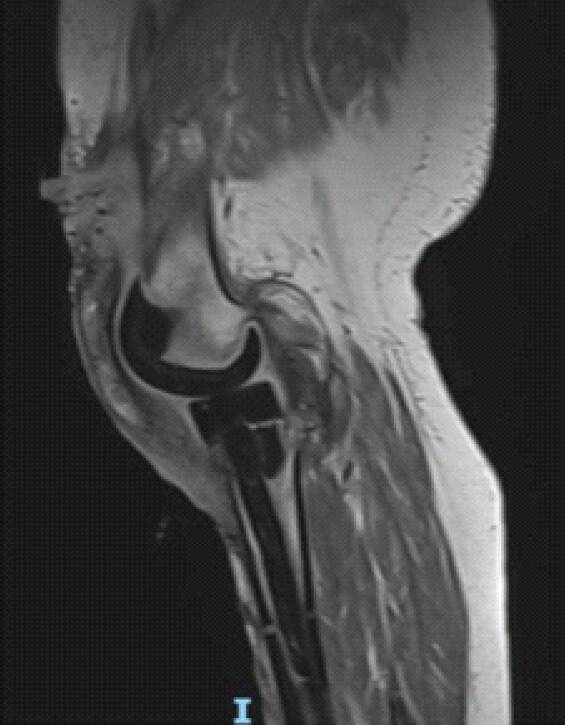 Figure 1: Lateral suprapatellar collection in communication with the joint space and femoral implant, with cutaneous sinus tract after a repeat Stage I revision right total knee replacement.