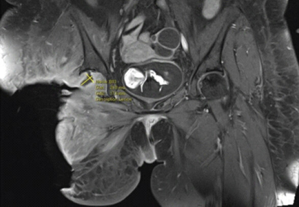 Figure 2: Remnant sinus tract extending into the right acetabular fossa after hip disarticulation.