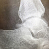 Figure 1: Initial lateral ankle radiograph obtained on December 28, 2025, demonstrating subtle cortical irregularity of the posterior malleolus (arrow), consistent with a non-displaced fracture. The ankle mortise is preserved.