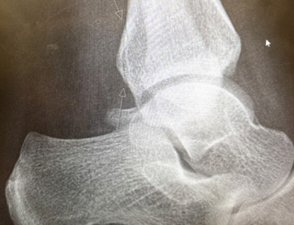 Figure 1: Initial lateral ankle radiograph obtained on December 28, 2025, demonstrating subtle cortical irregularity of the posterior malleolus (arrow), consistent with a non-displaced fracture. The ankle mortise is preserved.
