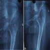 Acetabular Giant Cell Tumor Presenting with Protrusio Acetabuli: A Rare Case Report
