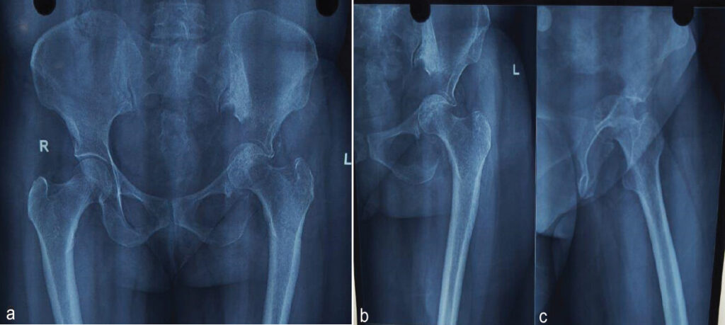 Figure 1: [a]Pre-operative anteroposterior radiograph and [b &c ]lateral view of the pelvis with hip showing protrusio acetabuli.
