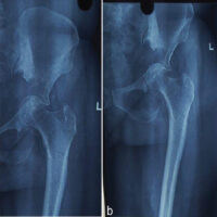 Figure 1: [a]Pre-operative anteroposterior radiograph and [b &c ]lateral view of the pelvis with hip showing protrusio acetabuli.