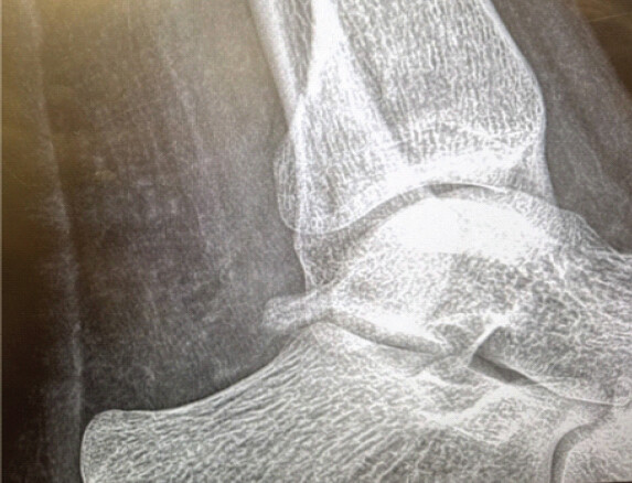 Figure 2: Follow-up lateral ankle radiograph obtained on January 28, 2026, demonstrating persistent cortical irregularity of the posterior malleolus without interval displacement. Alignment remains preserved.