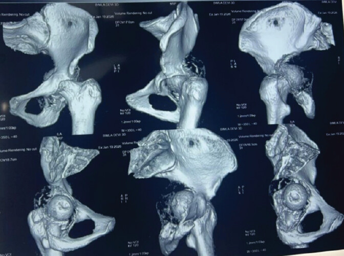 Figure 2: 3D computed tomography scan demonstrating cortical thinning and breach of the acetabular walls, with involvement of the weight-bearing dome.
