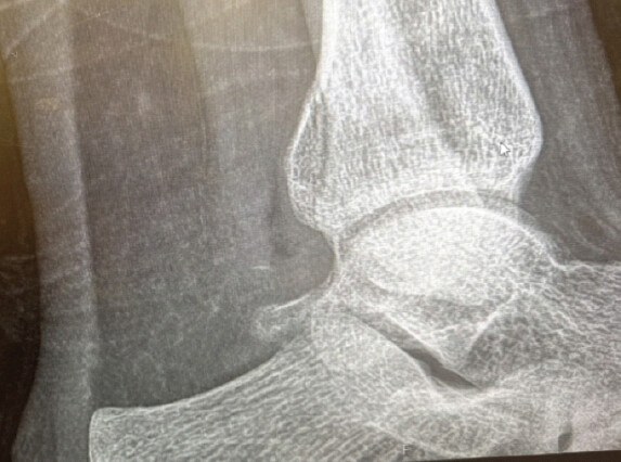 Figure 3: Follow-up lateral ankle radiograph obtained on February 25, 2026, demonstrating interval bony union of the posterior malleolus fracture with maintained ankle mortise congruency.