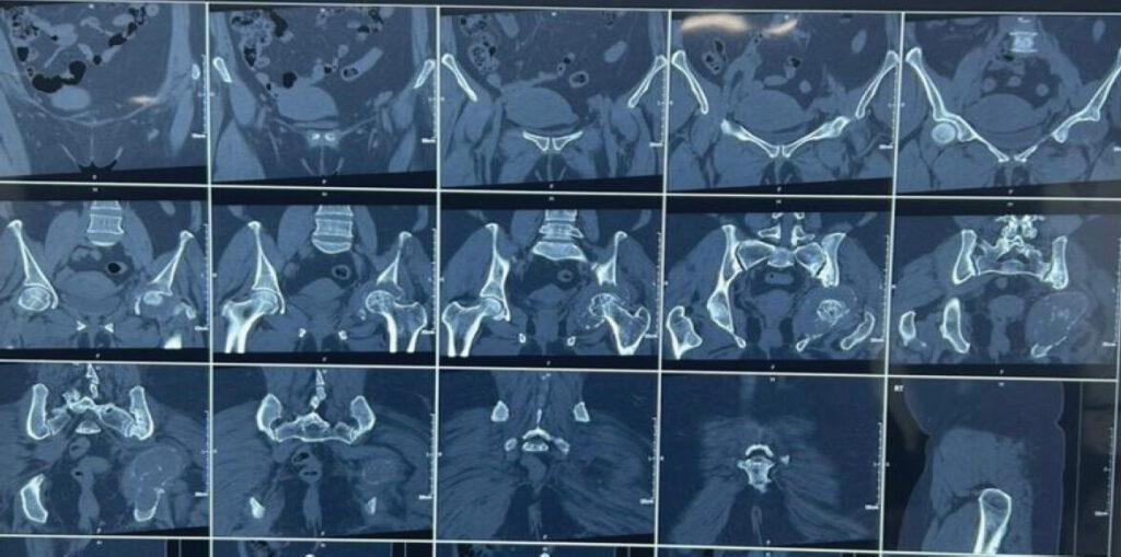 Figure 3: Magnetic resonance imaging (T2/short tau inversion recovery) showing a hyperintense lesion with cystic areas, articular cartilage involvement, and mild joint effusion.