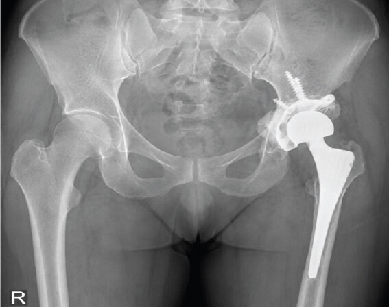 Figure 4: Immediate post-operative X-ray.