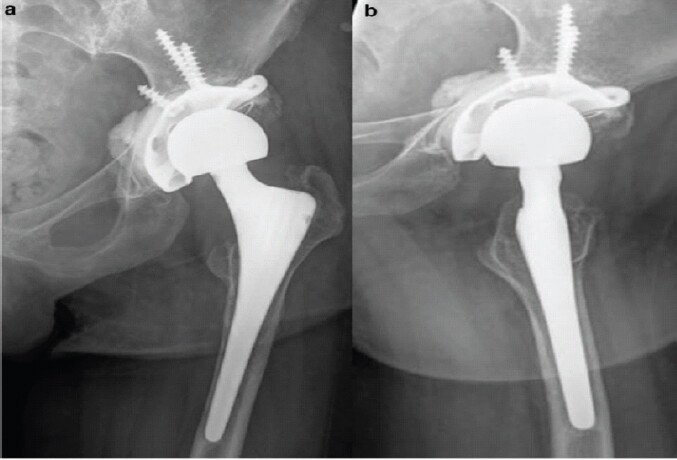 Figure 5: Follow-up X-ray. At 6 months, showing anteroposterior and lateral view