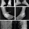 Bilateral Cedell Fractures of the Talus Associated with Ankle Fractures in a Polytrauma Patient: A Rare Injury Managed with Damage Control Orthopedics and Staged Fixation