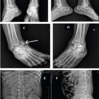 Figure 1: Initial radiographs following high-energy trauma. (a) Anteroposterior view of both ankles demonstrating posteromedial talar process fractures. (b) Lateral view of both ankles. (c) Right ankle showing fracture-dislocation with medial malleolus involvement. (d) Left ankle demonstrating distal tibial plafond fracture. (e and f) Anteroposterior and lateral radiographs of the lumbar spine showing L3 bony Chance fracture.