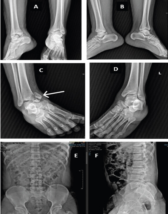Figure 1: Initial radiographs following high-energy trauma. (a) Anteroposterior view of both ankles demonstrating posteromedial talar process fractures. (b) Lateral view of both ankles. (c) Right ankle showing fracture-dislocation with medial malleolus involvement. (d) Left ankle demonstrating distal tibial plafond fracture. (e and f) Anteroposterior and lateral radiographs of the lumbar spine showing L3 bony Chance fracture.