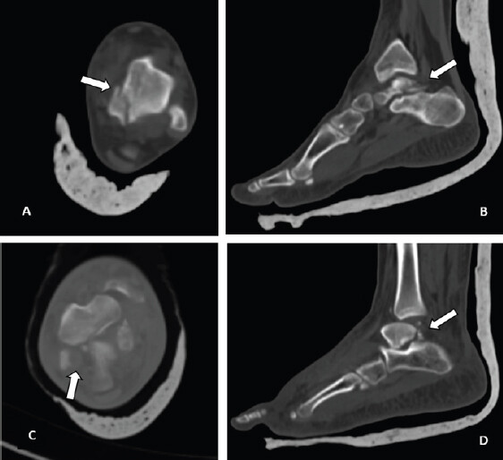 Figure 2: Axial and sagittal computed tomography images of the left (a and b) and right (c and d) ankles, confirming posteromedial talar process fractures (arrows) and delineating fragment size, displacement, and subtalar joint involvement.