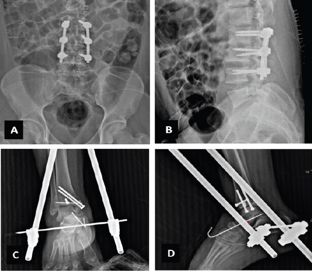 Figure 3: Post-operative radiographs following Stage 1. (a and b) Posterior spinal instrumentation from L2 to L4 level. (c and d) Right ankle: Open reduction and internal fixation of medial malleolus with ankle-spanning external fixator (anteroposterior and lateral views). A retained broken intraoperative Kirschner wire fragment adjacent to the talus was left in situ, being extra-articular and stable.