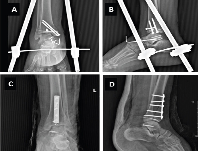 Figure 4: Post-operative radiographs following Stage 2. (a and b) Right ankle: Fixation of the posteromedial talar process fracture using headless compression screws. (c and d) Left ankle: Headless compression screw fixation of talar fracture with plate and screw fixation of the tibial plafond.