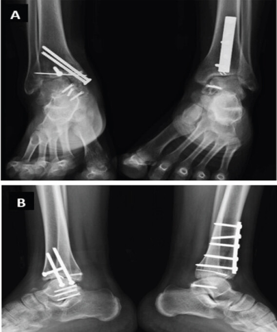 Figure 5: Six-month follow-up radiographs demonstrating complete bilateral union. Bilateral ankle (a) Anteroposterior view (b) Lateral view. The retained Kirschner wire fragment remained stable and asymptomatic.