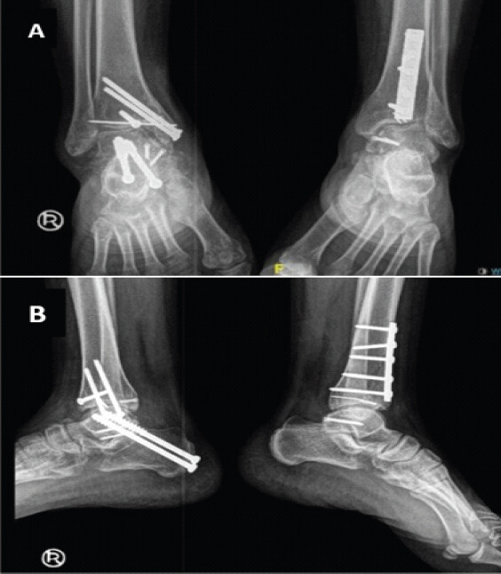 Figure 6: (a and b) Post-operative radiograph after subsequent subtalar arthrodesis, demonstrating solid fusion across the subtalar joint.