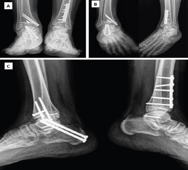 Figure 7: One-year post-operative radiographs of the right and left ankle. (a) Anteroposterior view, (b) Mortise view, and (c) Lateral view radiographs demonstrating complete union of the bilateral distal tibial and posteromedial talar process fractures with maintained reduction, stable implant position, restoration of the ankle mortise, preserved tibiotalar joint congruity, successful right subtalar arthrodesis, and no evidence of implant loosening or talar avascular necrosis.