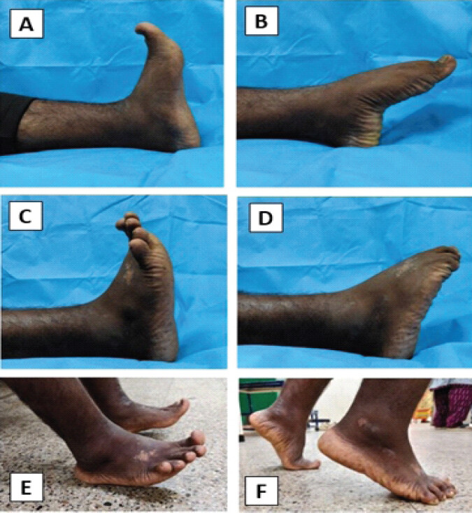 Figure 8: One-year clinical follow-up demonstrating functional outcome following staged fixation and subsequent subtalar fusion. Active left ankle dorsiflexion (a) and plantarflexion (b). Active right ankle dorsiflexion (c) and plantarflexion (d), with active flexion of the great toe demonstrating preserved flexor hallucis longus function(e). Toe-standing demonstrating restoration of functional weight-bearing (f). Leg heel rise demonstrating preserved ankle plantarflexion strength, satisfactory hindfoot stability, and return to functional activity.