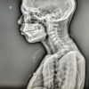 Cervicodorsal Pott’s Spine with Acute Onset Paraplegia Managed by Transmanubrial Anterior Decompression and Instrumentation: A Case Report